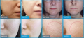 Maszyna Glowskin O+ Czyszczenie Pielęgnacja Twarzy